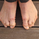 dita dei piedi piegate